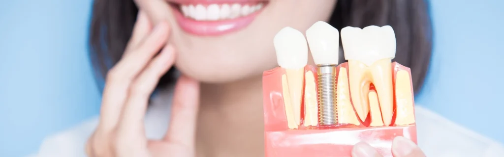 Are dental implants safe or risk