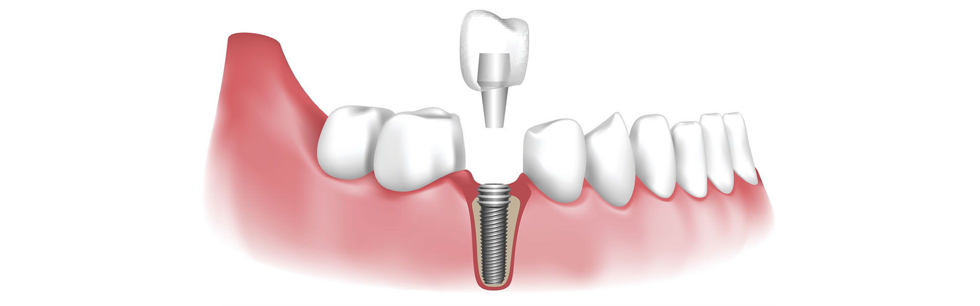 What are the latest dental implant technologies